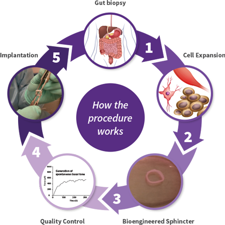 How the procedure works